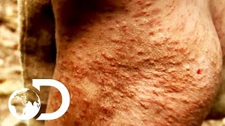 Invasion of the Insect Bites | Naked and Afraid