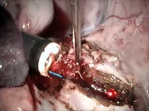 NOTES – Surgery Using Natural Orifice (Transgastric)