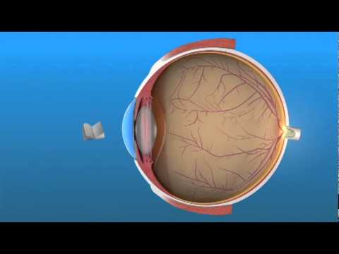 Presbyopia information