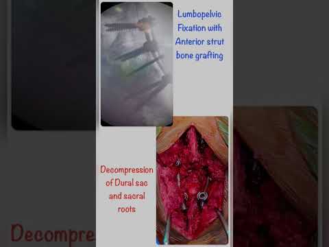 Spine TB | kyphosis | FineSpine