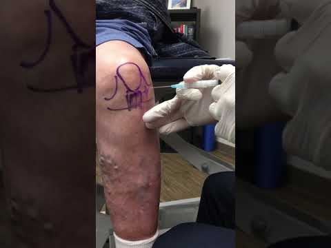 Anterior Knee Injection - Elite Sports Medicine - Lethbridge