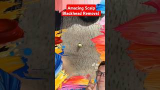 Crazy Random BLACKHEAD REMOVAL - Blackhead On Scalp #shorts