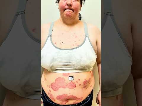 Testimonio de paciente