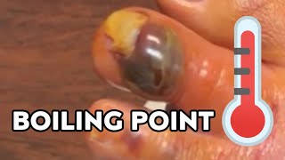 NAIL REMOVAL WITH BLOOD BLISTER