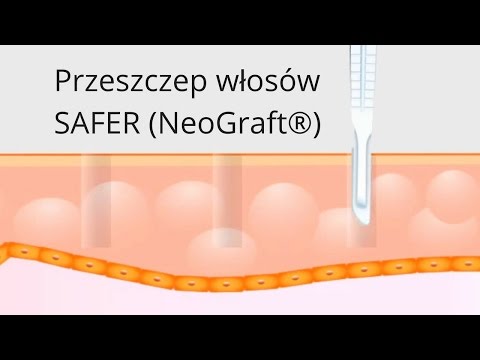 Środki folk szybki otraschivaniya włosy Łysina żadnych opinii