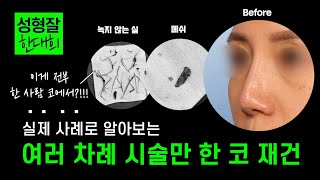 EDITION TV - 코 시술만 해오신 환자분께서 무보형물 코성형 한 진짜 이유