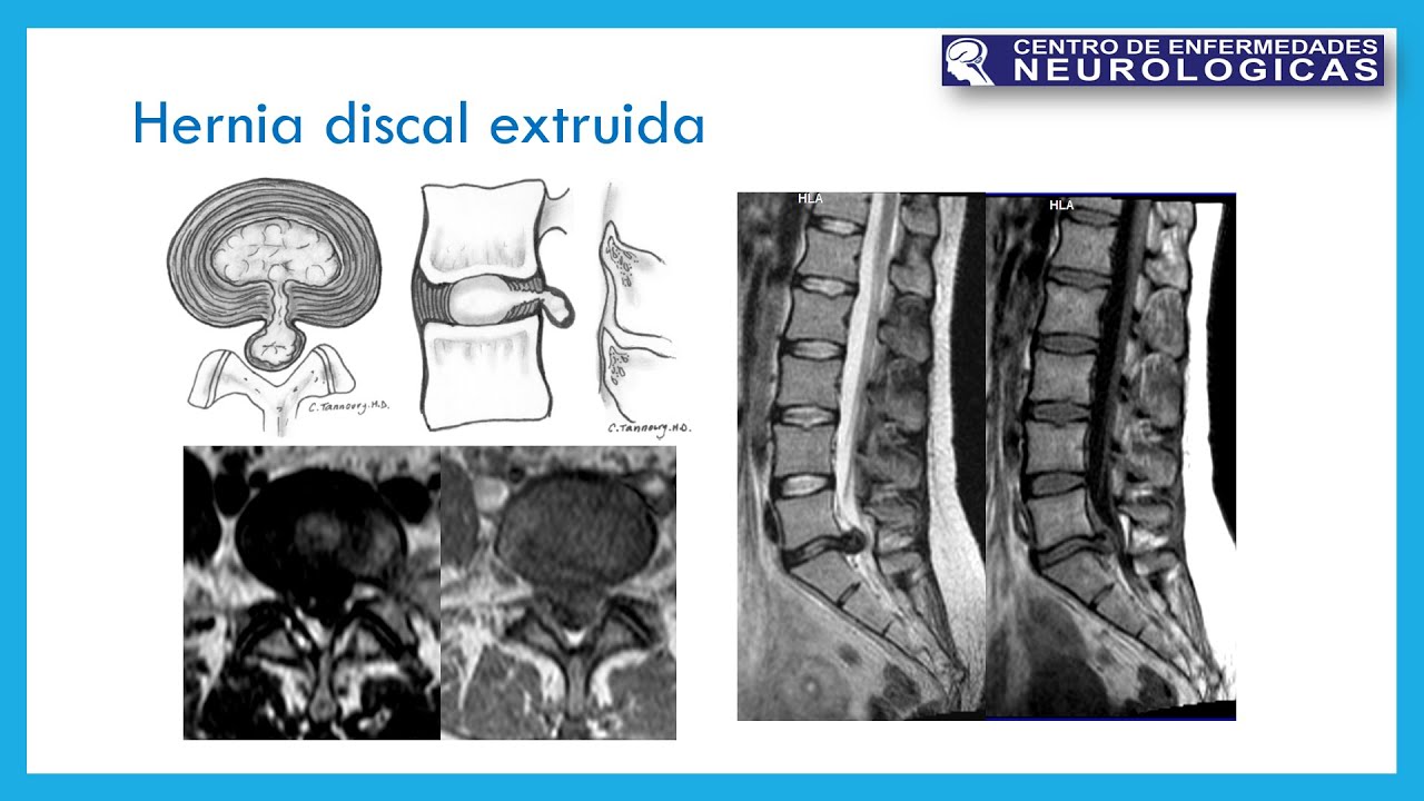 Hernia de disco intervertebral II