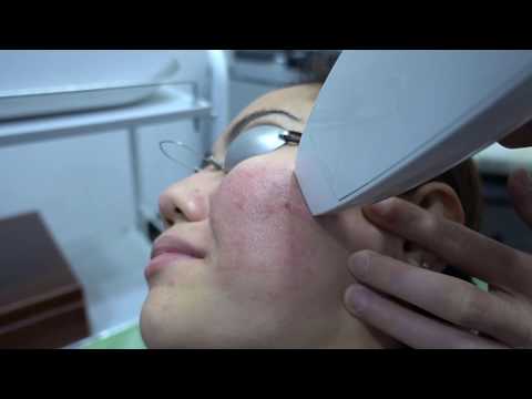 Fractional Skin Resurfacing (Venus Viva) for Acne Scars - Dr Ho Rui Ming, Singapore