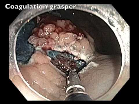 Krwawienie po endoskopowej resekcji śluzówki - koagulacja zmiany