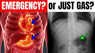 Pain Under Left Rib Cage: EMERGENCY... or Just Gas