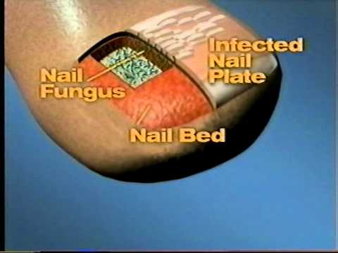 Halamang-singaw sa pagitan ng iyong mga binti sa singit sa mga babae Creams laban sa fungi ng paa