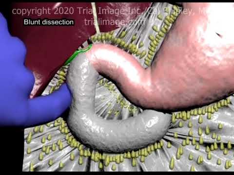 Kocher Maneuver (in 2 minutes) Animation by Cal Shipley, M.D.