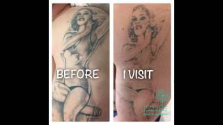 renude laser tattoo removal
