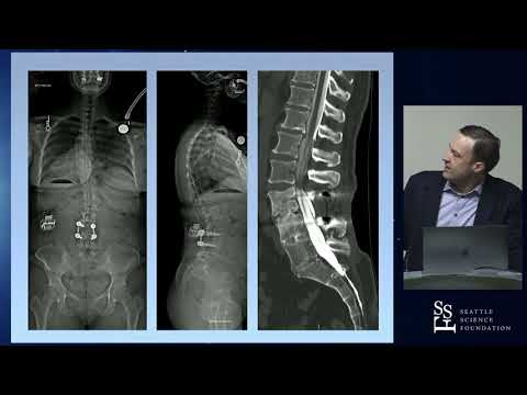 Avoidance and Treatment of Rod Fractures  - Justin S. Smith, MD, PhD
