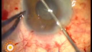 Phacoemulsification in small pupil