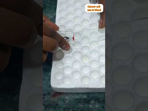 cancer cell under Microscope #cancer #short #shorts #microscope #viral #bloodcancer