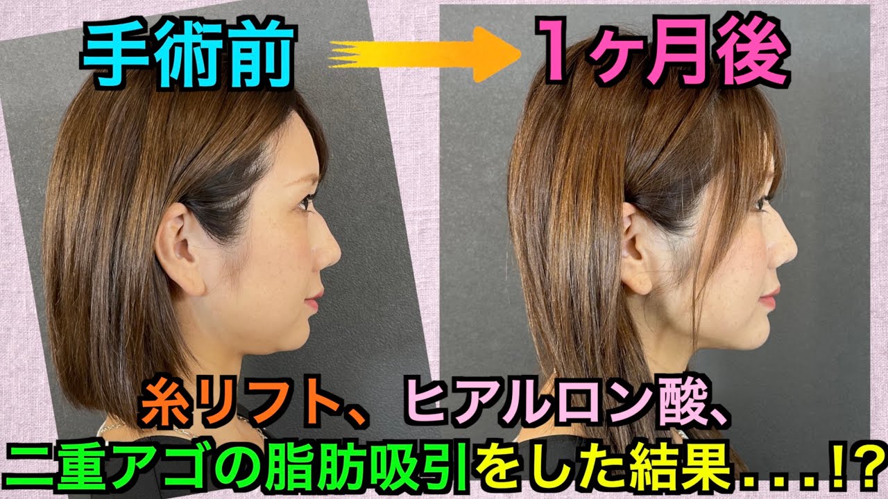 【後編】糸リフトやヒアルロン酸の効果、ダウンタイムの闇【本音】