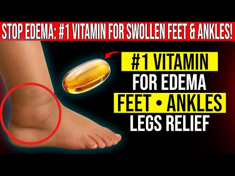 STOP Edema! The #1 Vitamin That Instantly Calms Swollen Feet, Ankles, and Legs