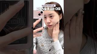 피부시술 못 끊는 이유! (계속 예뻐져요)