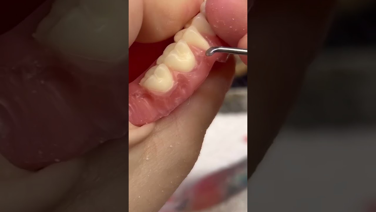 Carving the gum line