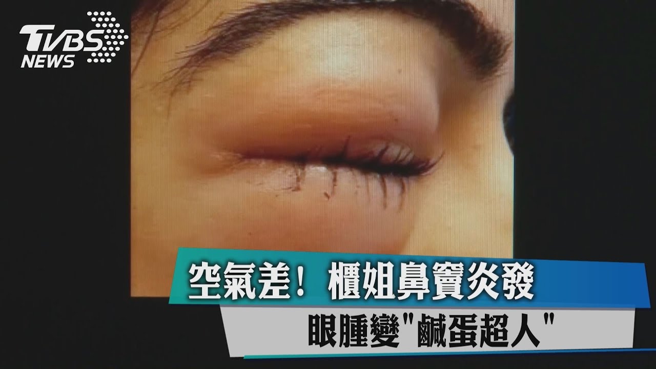 空氣差！櫃姐鼻竇炎發　眼腫變「鹹蛋超人」