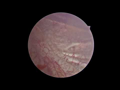 Chyluria as seen in cystoscopy from right side