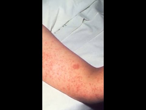 Third person dies in Pennsylvania measles outbreak