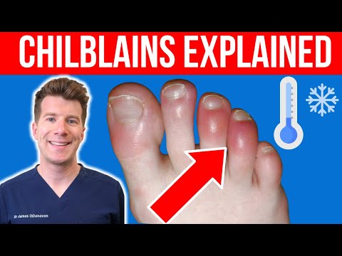 Doctor explains CHILBLAINS (Pernio) | Causes, symptoms and treatment
