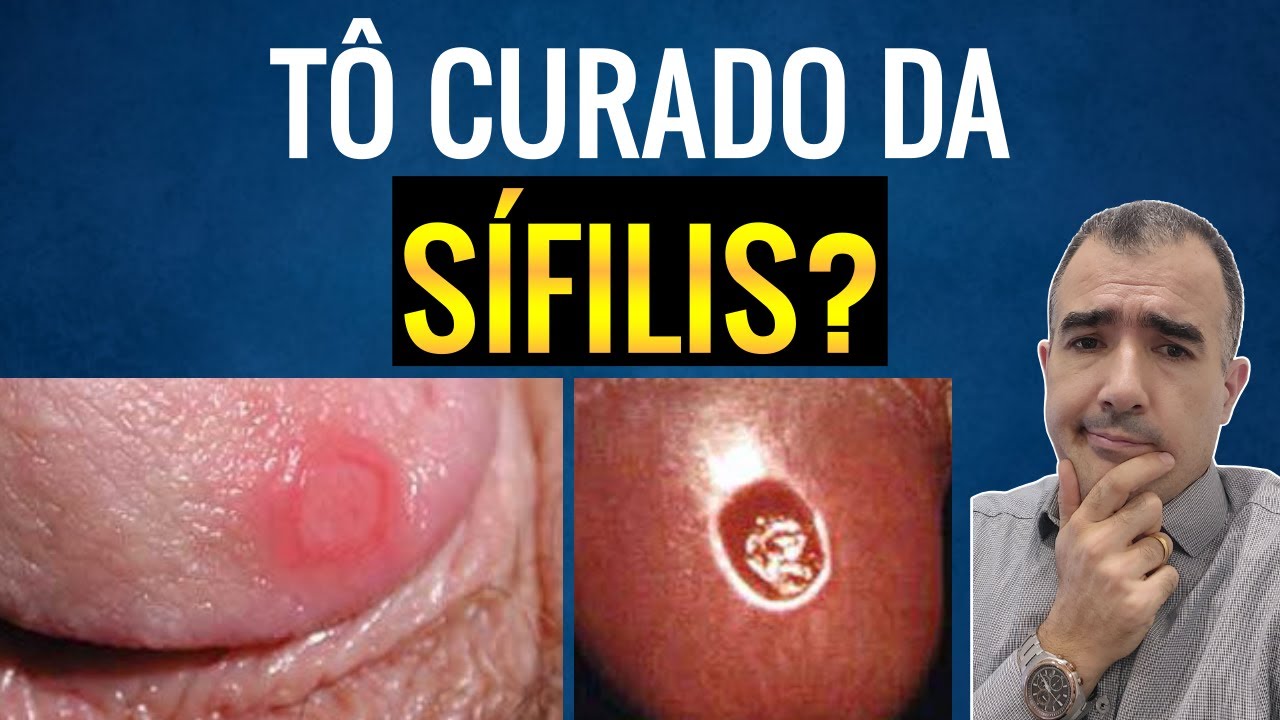 Como saber, após o tratamento, se você ficou curado da SÍFILIS?