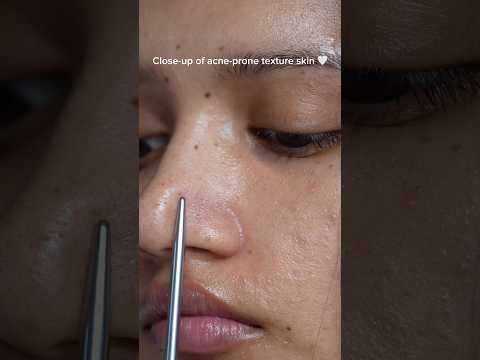 If your skin looks like this up close, you’re not alone.This is just acne-prone skin being real.