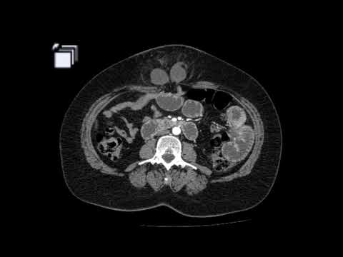 Achados clínicos e tomográficos de uma hérnia intestinal estrangulada na parede abdominal