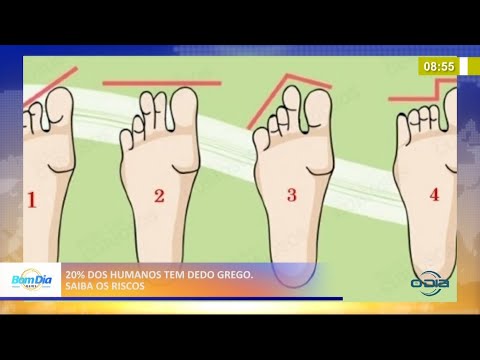 20% dos humanos têm dedo grego; saiba os riscos 26 04 2021