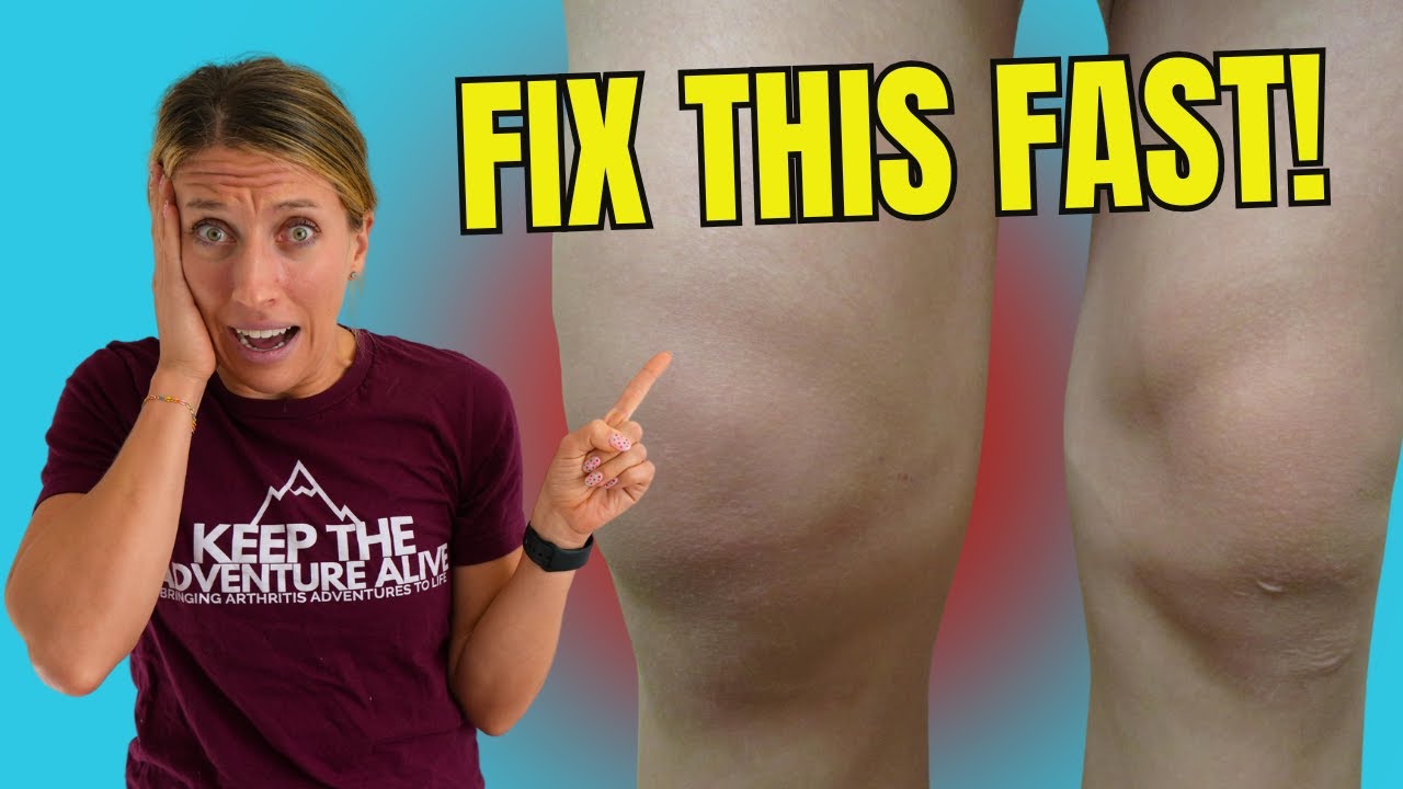 Struggling with Knee Swelling? 3 Proven Ways to Bring It Down Fast!