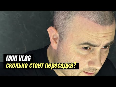 Сколько стоит пересадка волос в России? Андрей Алистаров