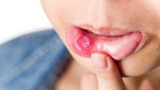 6 Ways: How To Cure Mouth Ulcer Permanently In One Day.