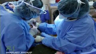Dr. Nassif’s Closed Rhinoplasty How To – Spreader Grafts