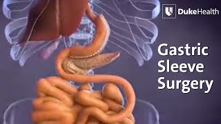 Gastric Sleeve Surgery | Duke Health
