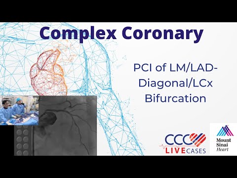 PCI of LM/LAD-Diagonal/LCx Bifurcation - August 21, 2018