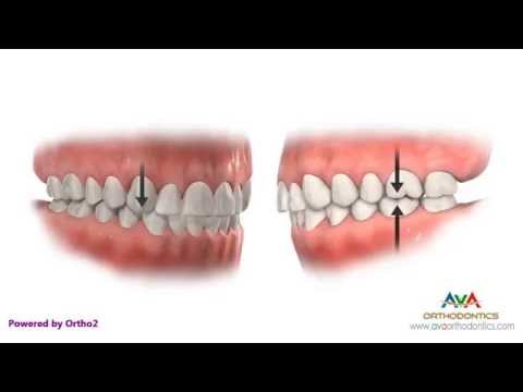 Malocclusion - Class I Crowding