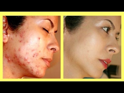 TOP 4 WAYS How To Get Rid Of Acne Scars overnight naturally at home Video
