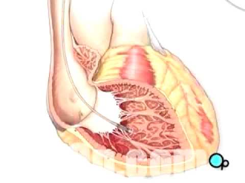 PreOp® Patient Education Permanent Pacemaker Implant Surgery
