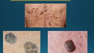 Skin cancer education