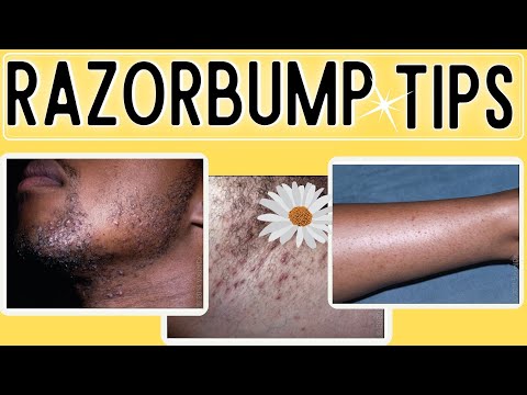 How to Get rid of Razor Bumps| Ingrown hairs