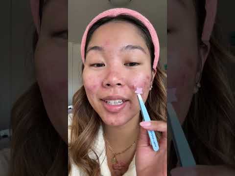 do the viral star pimple patches actually work or are they just cute #pimplepatch #starpimplepatch