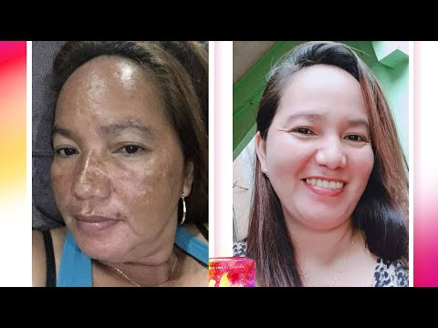 Melasma (Pekas) Problem? No Worries use SCD Peeling Lotion para Goodbye Pekas!