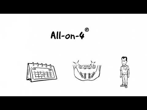 Πλεονεκτήματα Της Τοποθέτησης Οδοντικών Εμφυτευμάτων Με Τη Μέθοδο All-on-4®