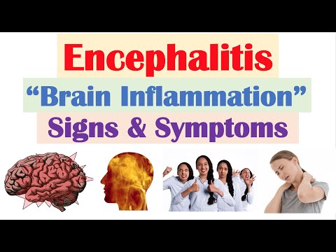 Encephalitis (“Brain Inflammation”) Signs and Symptoms (& Why They Occur)