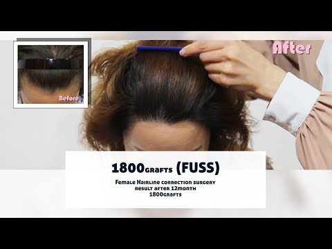 Female Hairline correction surgery results after 12 month - 뉴헤어 I 헤어라인 I Before and After I