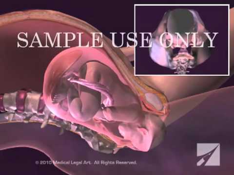 Childbirth - Normal Vaginal Delivery