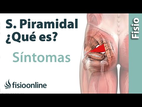 ¿Qué es el síndrome del músculo piramidal y cuáles son sus síntomas y causas?